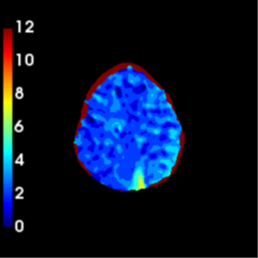 File:Left MCA and ICA occlusion, endovascular clot retrieval ...