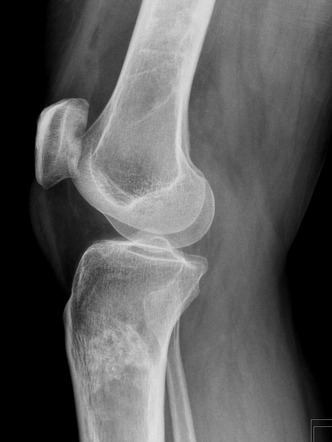 Bone infarct | Radiology Case | Radiopaedia.org