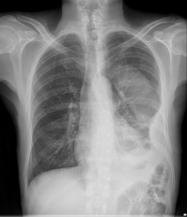 Pleural empyema | Image | Radiopaedia.org