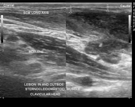 Tuberculous cervical lymphadenitis | Radiology Case | Radiopaedia.org