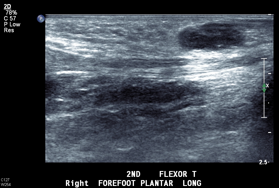 Plantar fibromatosis | Image | Radiopaedia.org