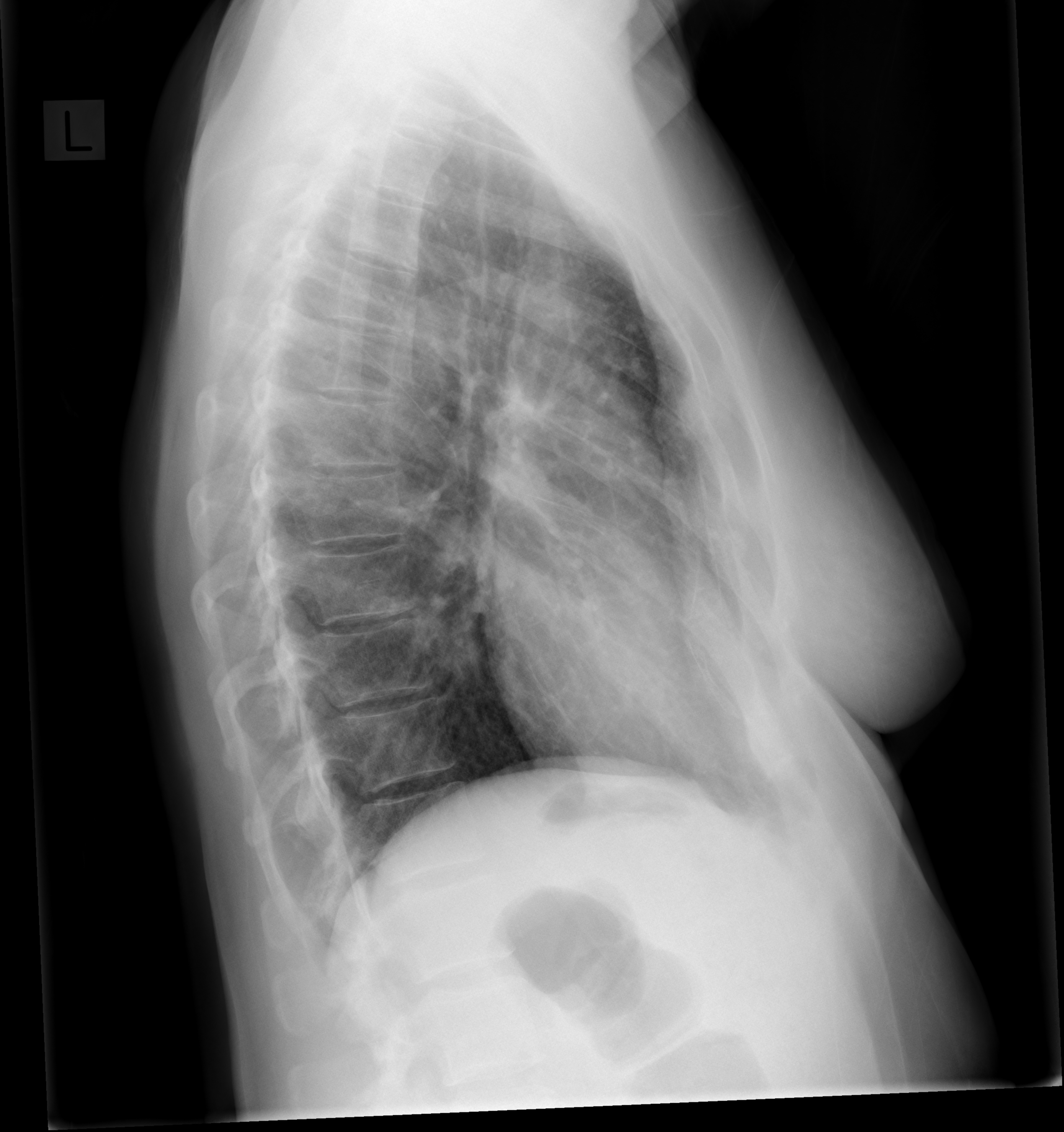 Pectus excavatum | Image | Radiopaedia.org