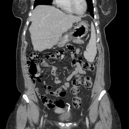 IUCD peritoneal cavity migration | Image | Radiopaedia.org