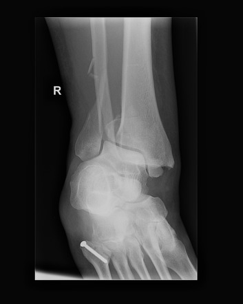 trimalleolar fracture