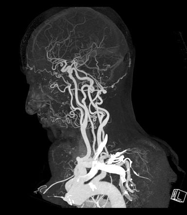 Fenestration of the vertebral artery | Image | Radiopaedia.org