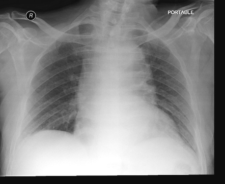 Vocal cord palsy - thoracic aortic aneurysm | Image | Radiopaedia.org