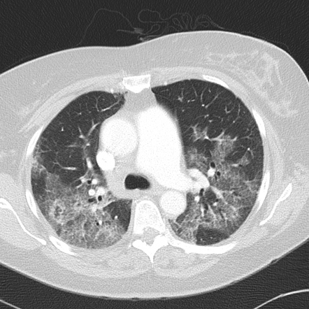 Pulmonary fat embolism | Radiology Reference Article | Radiopaedia.org