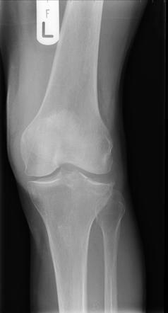 Tibial plateau fracture and lipohaemarthrosis | Radiology Case ...