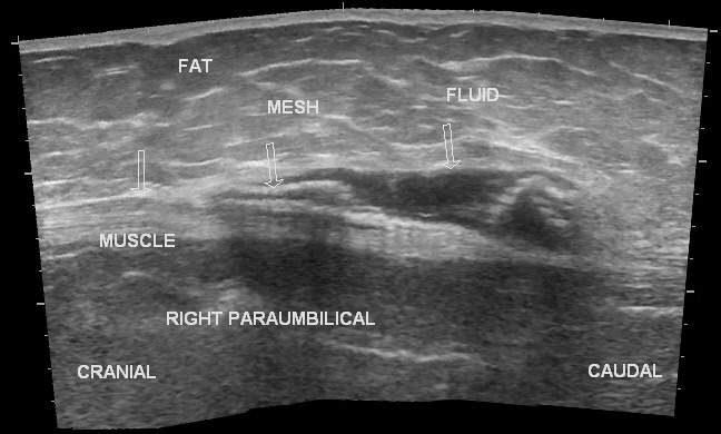 what-is-a-hematoma-after-hernia-surgery-peter-brown-b-vrogue-co