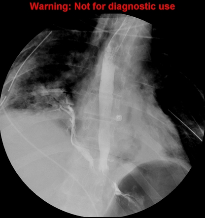 Esophageal perforation (Boerhaave syndrome) | Radiology Case ...