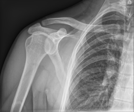 Bony Bankart lesion | Image | Radiopaedia.org