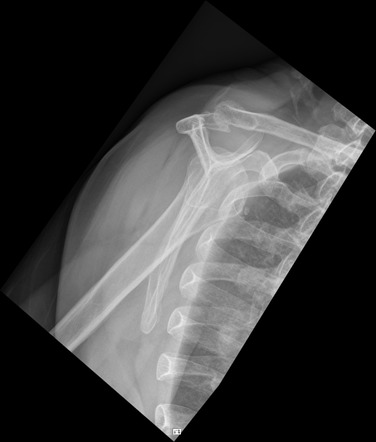 Glenoid fossa fracture | Image | Radiopaedia.org