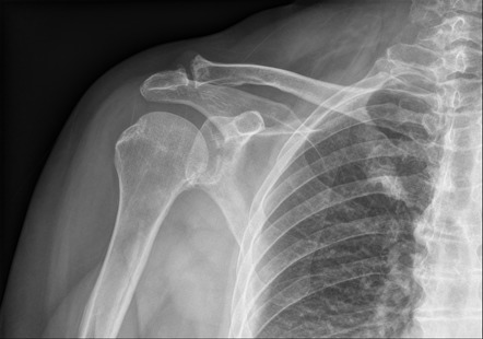 Scapula Glenoid Fossa