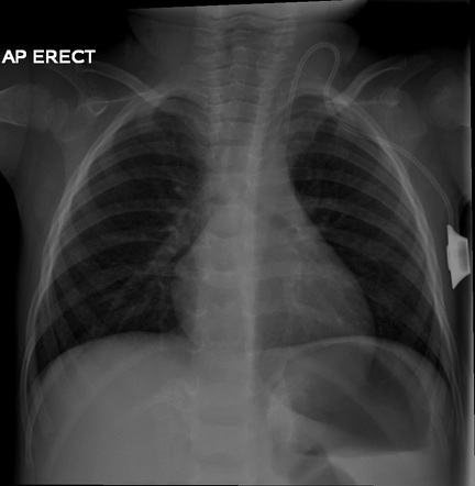 Wolman disease | Radiology Case | Radiopaedia.org