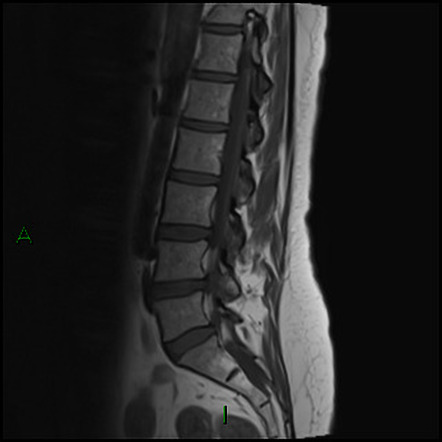 Spinal schwannoma | Radiology Case | Radiopaedia.org