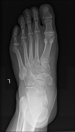 Mueller Weiss syndrome | Radiology Case | Radiopaedia.org