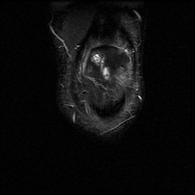 Chondromalacia patellae | Image | Radiopaedia.org