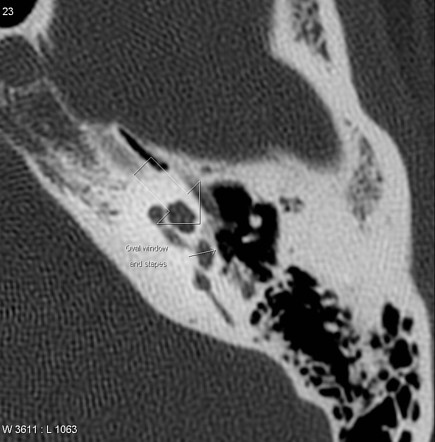 otosclerosis otoscopy