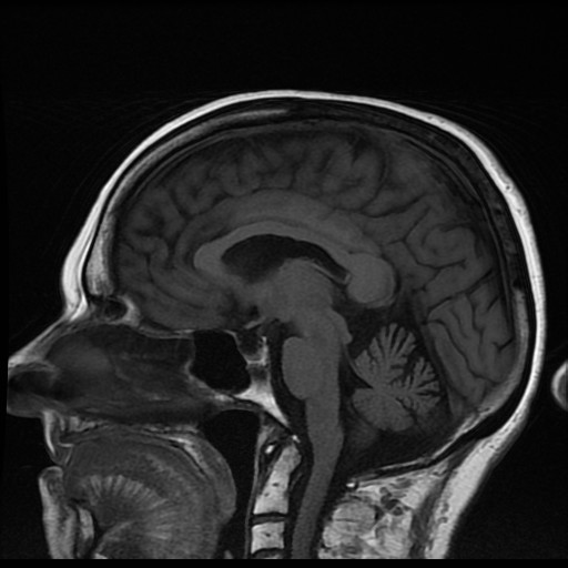 Cystic brain metastases from ovarian mucinous carcinoma | Image ...