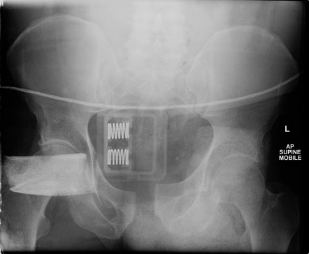 Open book pelvic injury, Radiology Reference Article