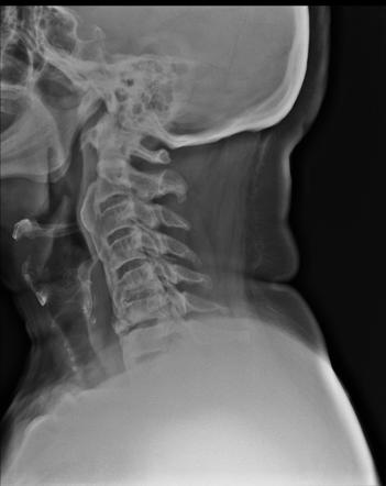 Diffuse idiopathic skeletal hyperostosis | Radiology Reference Article ...