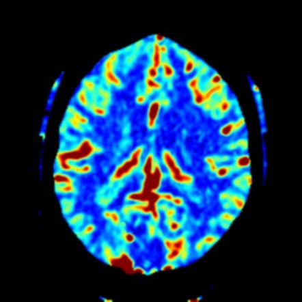 Left MCA stroke with tandem carotid occlusion | Image | Radiopaedia.org