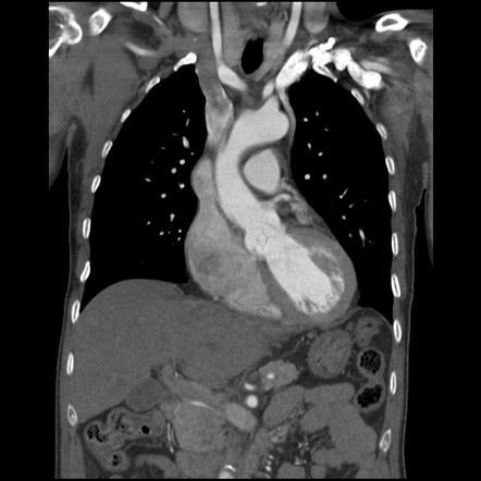 Persistent left SVC | Radiology Case | Radiopaedia.org