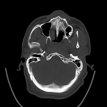 Temporomandibular joint dislocation - bilateral | Image | Radiopaedia.org