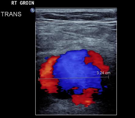 Femoral Artery Pseudoaneurysm