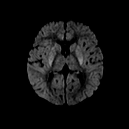 hypoxic encephalopathy radiopaedia brain ischemic drowning hie radiology dwi