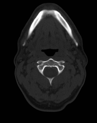 Thyroglossal Duct Cyst | Image | Radiopaedia.org