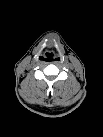 Thyroglossal duct cyst | Radiology Case | Radiopaedia.org