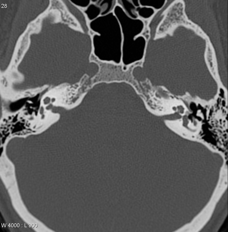 Otosclerosis Radiopaedia