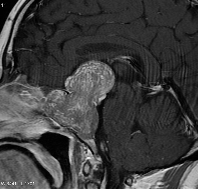 Chordoma | Radiology Reference Article | Radiopaedia.org