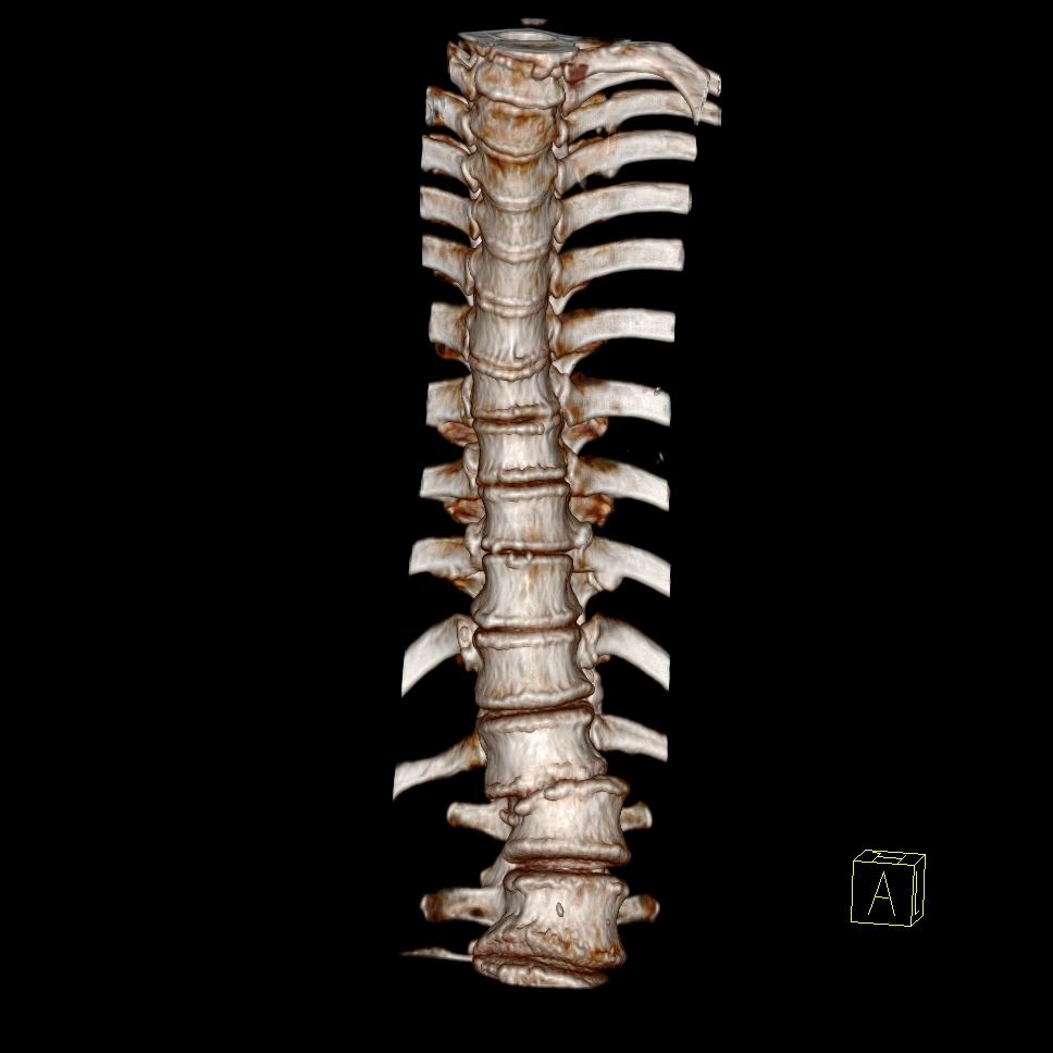 Lateral spondylolisthesis | Image | Radiopaedia.org