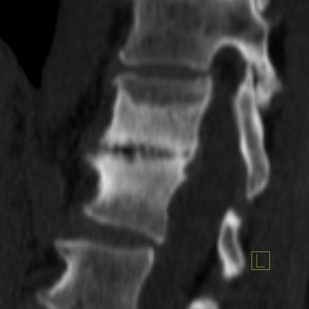 Lateral spondylolisthesis | Image | Radiopaedia.org