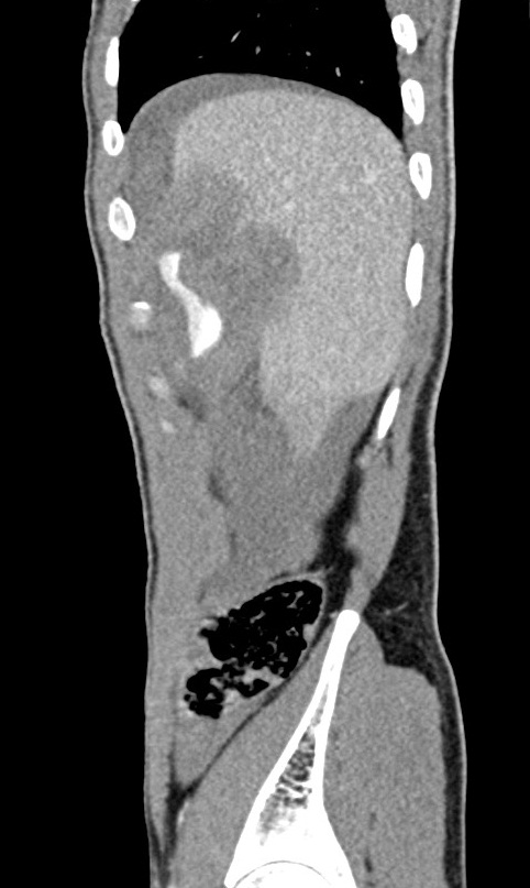 Liver laceration - AAST grade IV | Image | Radiopaedia.org