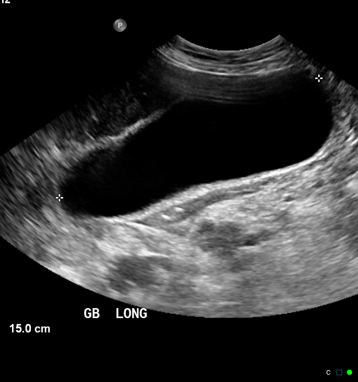 Malignant biliary obstruction - Courvoisier sign | Image | Radiopaedia.org