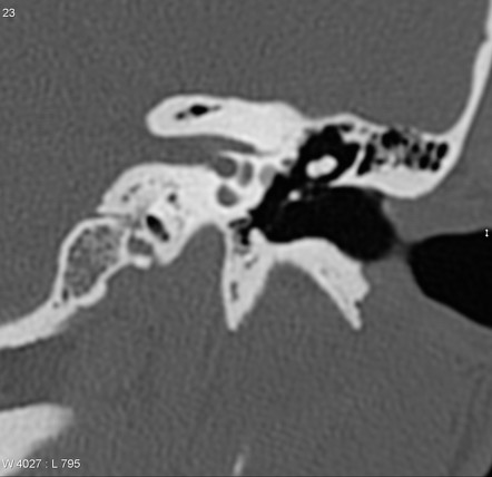 Otosclerosis Radiology Reference Article Radiopaedia Org