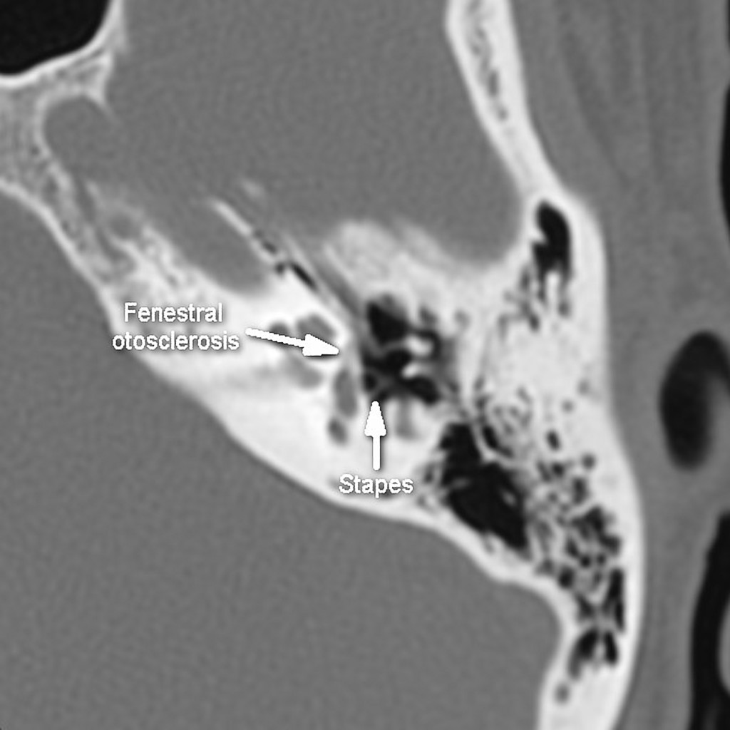 Retrospective Review Of Otic Capsule Contour And Thickness, 49% OFF