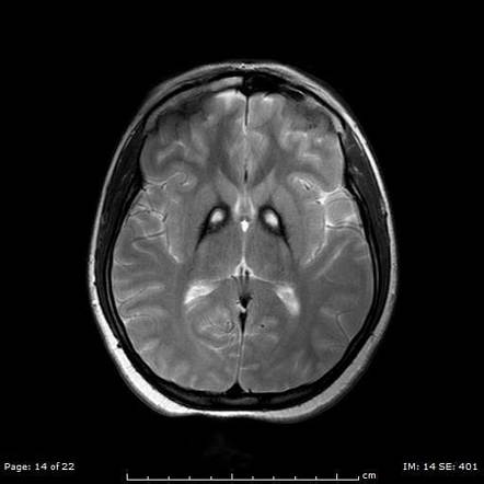 Eye Of The Tiger Sign Globus Pallidus Radiology Reference Article Radiopaedia Org