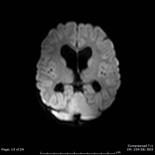 Ependymoma Image Radiopaedia Org