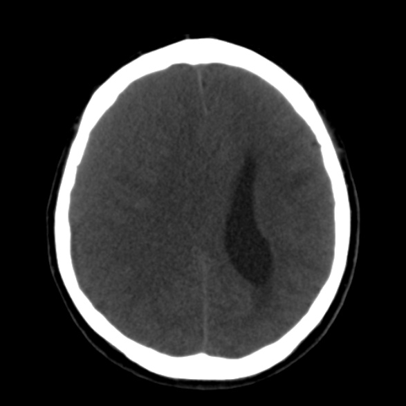 Subacute subdural hematoma | Image | Radiopaedia.org