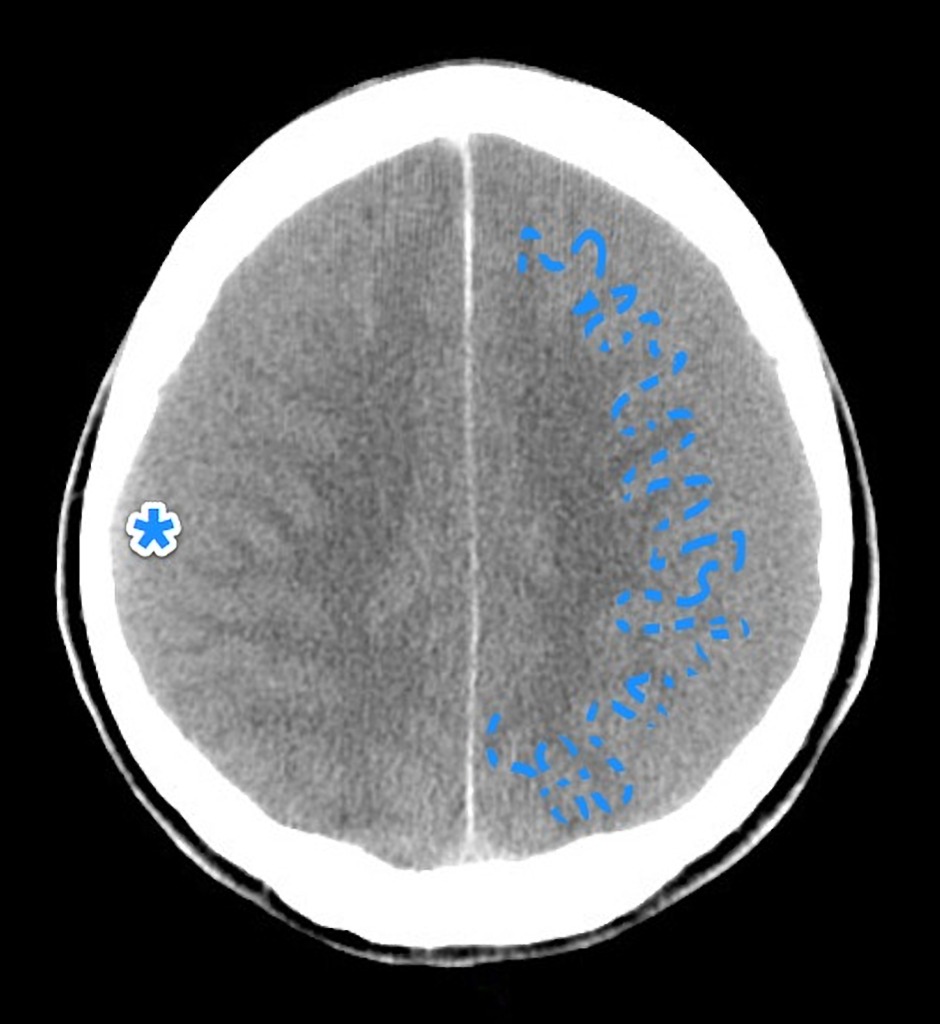 Subdural Hematoma Isodense Bilateral Radiology Case Radiopaedia Org