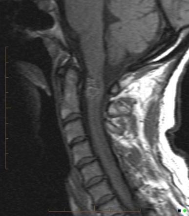 Hemangioma | Radiology Reference Article | Radiopaedia.org