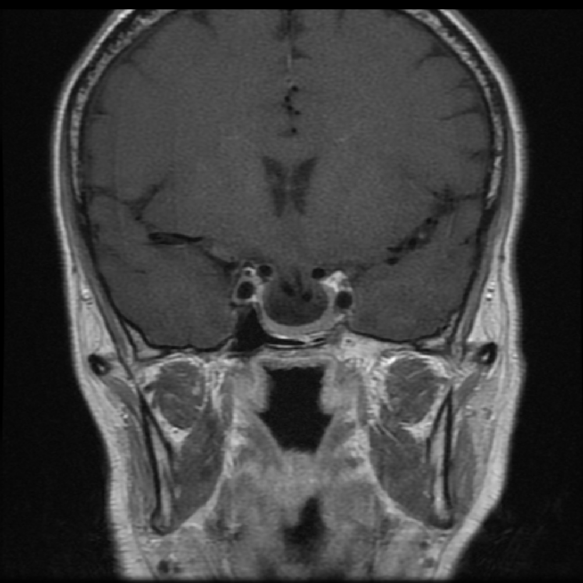 Herniation of the optic chiasm and third ventricle into a partial empty ...