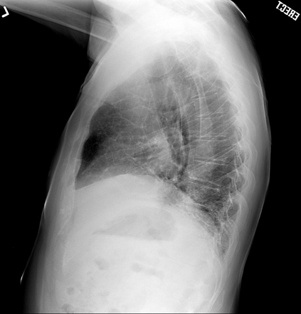 Polymyositis - with interstitial pneumonitis | Image | Radiopaedia.org