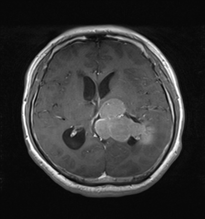 Intraventricular | Radiology Reference Article | Radiopaedia.org