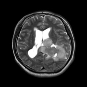 Meningioma Radiology Reference Article Radiopaedia Org