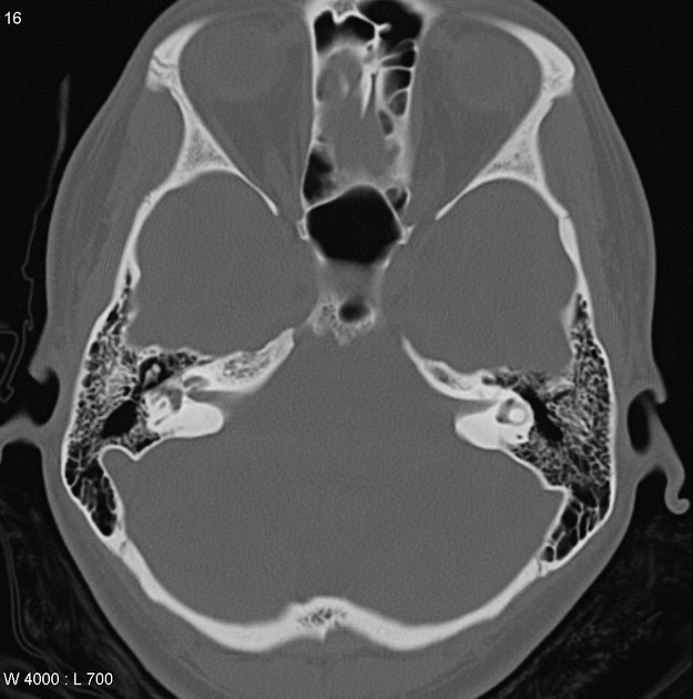 Retrofenestral Otosclerosis Radiology Case Radiopaedia Org